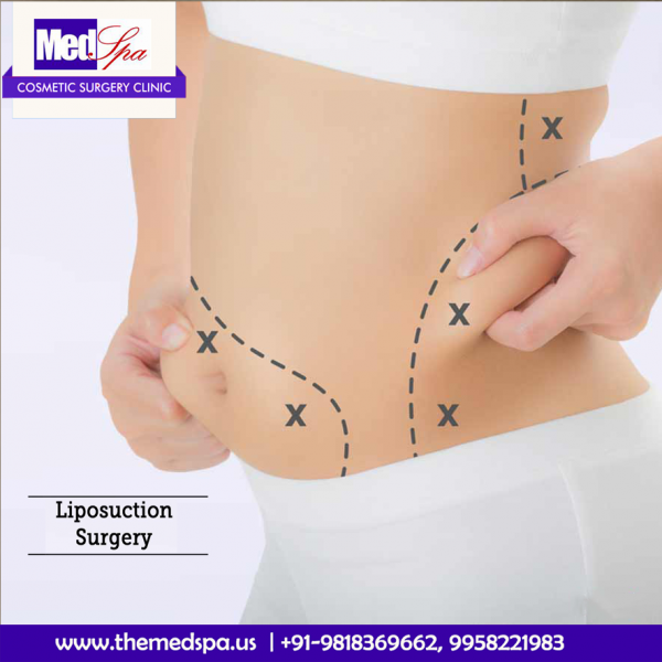 The Various Myths That Are Related To Liposuction!